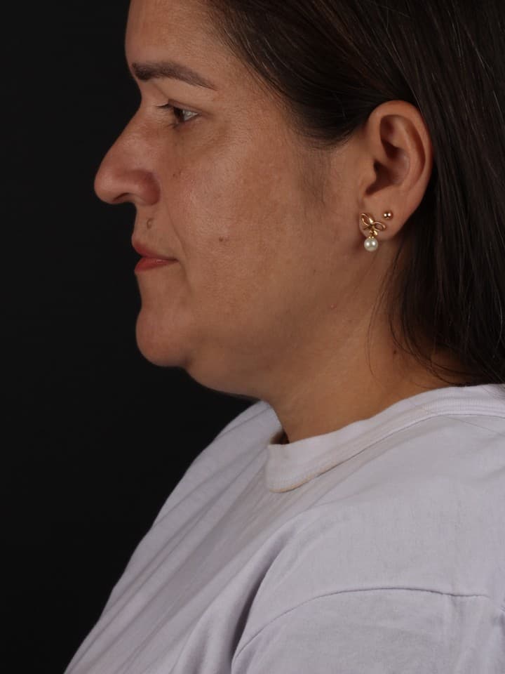 Cervicoplastia — antes e depois — Antes