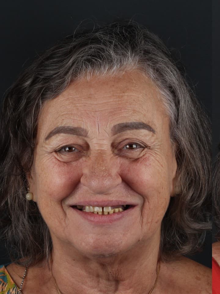 Reabilitação com implantes — antes e depois — Antes