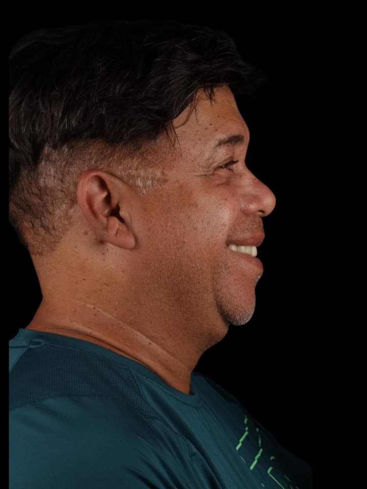Mentoplastia — avanço de queixo — antes e depois — Antes