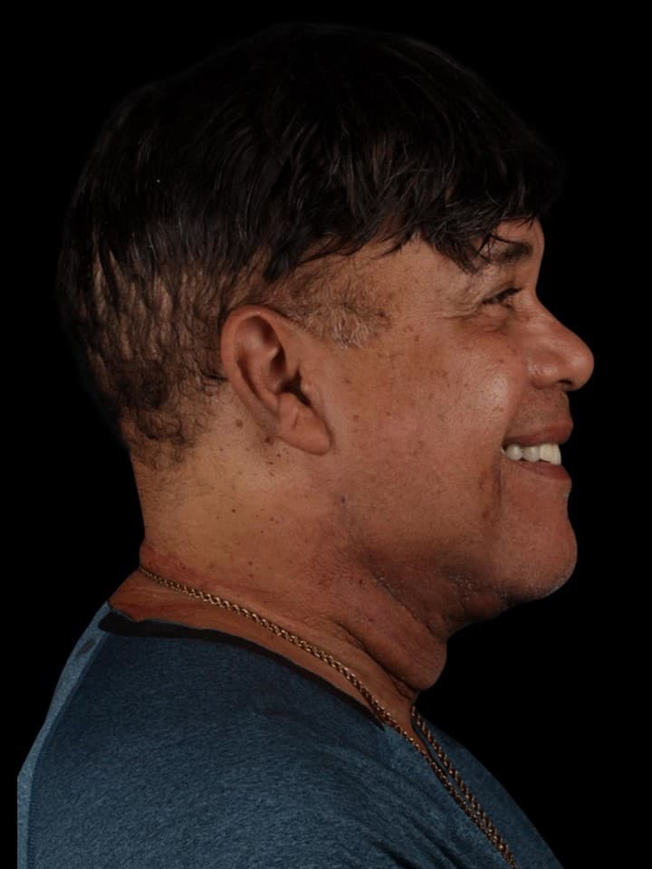Mentoplastia — avanço de queixo — antes e depois — Depois