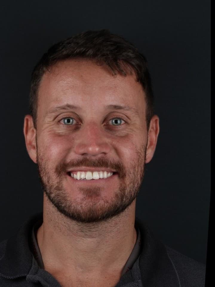 Cirurgia ortognática — antes e depois — Depois