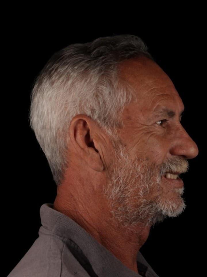 Implante zigomático — antes e depois — Antes