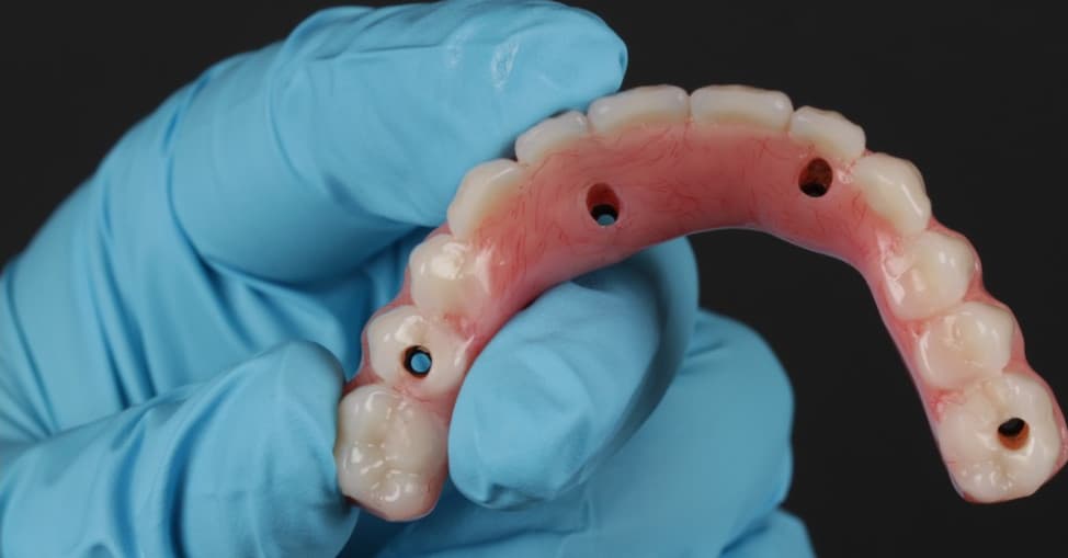 Face interna da prótese, com as perfurações de fixação nos implantes